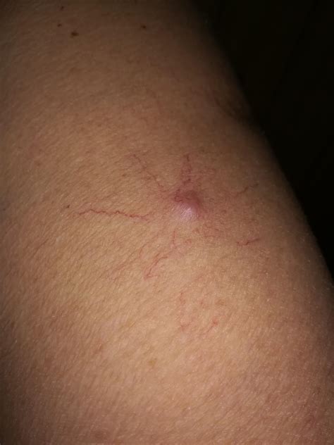 What Can This Be Its On The Upper Arm Of Am Elderly Wonam 70 Ish
