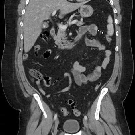 Axial Section Of Ct Abdomen With Iv Contrast Showing 15 Cm Hyperdense