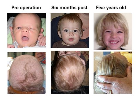 Craniosynostosis Minimally Invasive Treatment Childrens Hospital Of