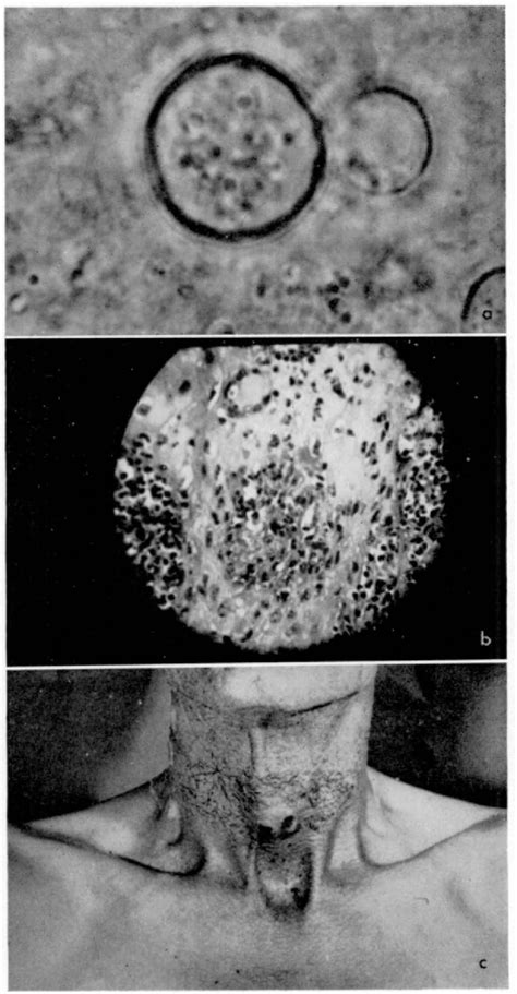 Figure 2 From Xiv Mycotic Disease Of The Larynx Semantic Scholar