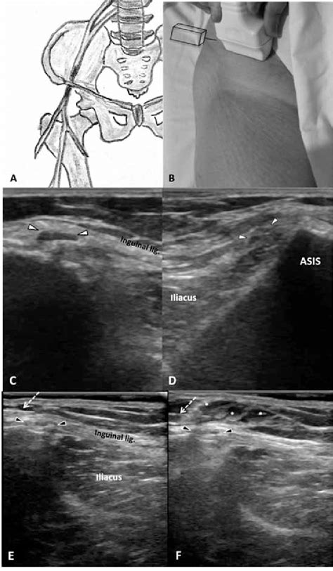 A Anatomic Position Of The Lateral Femoral Cutaneous Nerve B