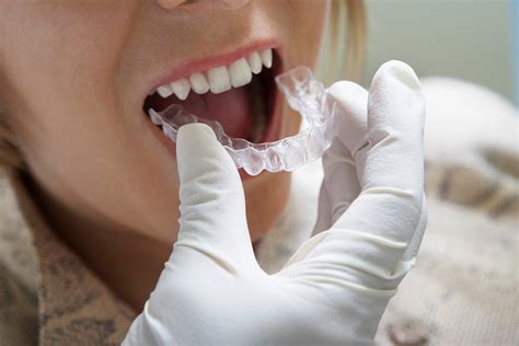 Alinhadores Ortodônticos O Futuro Da Ortodontia Estética E Funcional