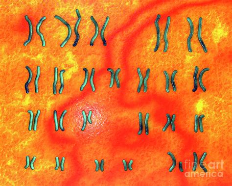 Karyotype Of Prader Willi Syndrome Photograph By Kateryna Kon Science
