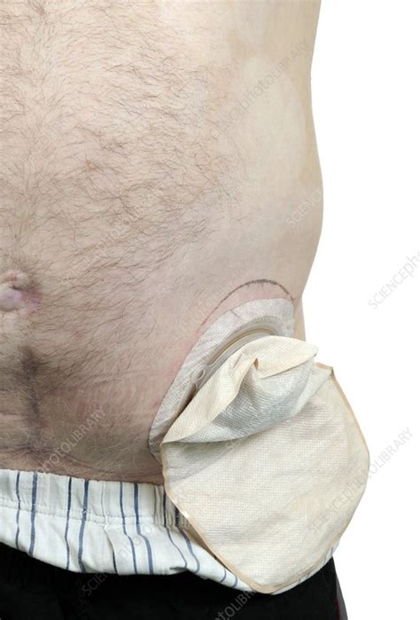Colostomy Stock Image C0106659 Science Photo Library