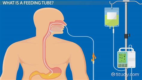 What Is A Feeding Tube Types And Complications Video And Lesson