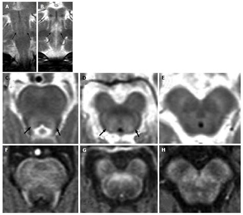 Magnetic Resonance Imaging Differential Diagnosis Of Brainstem Lesions