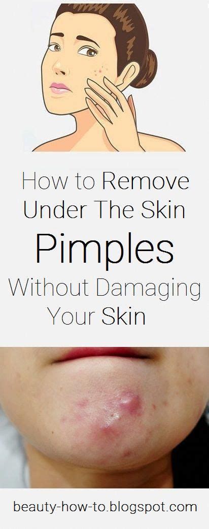 How To Remove Under The Skin Pimples Without Damaging Your Skin Under