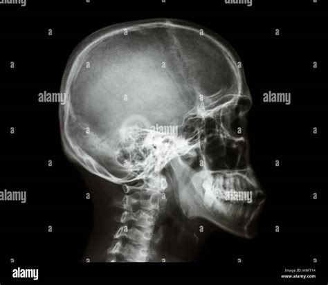 Film X Ray Skull And Cervical Spine Lateral View Stock Photo 126440416