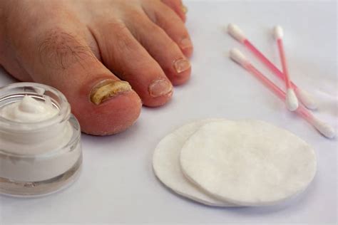 What Is The Best Topical Treatment For Nail Fungus Nycfellowship