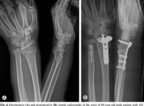 Figure 1 From Surgical Treatment Of Ulnar Metaphyseal Fracture