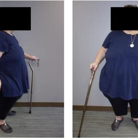 Preoperative Photographs Of The Patient At Lbs And Bmi Kg M