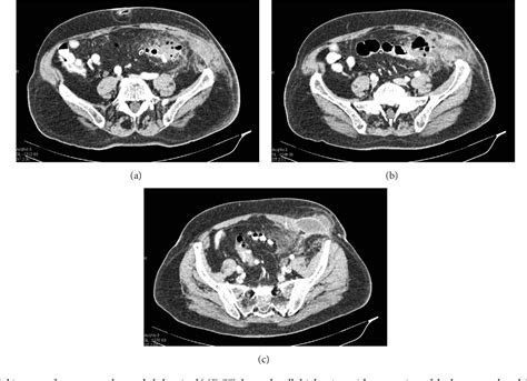Figure 2 From Abdominal Wall Abscess Due To Acute Perforated Sigmoid