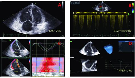 Echocardiographic Assessment After Five Months When The Patient
