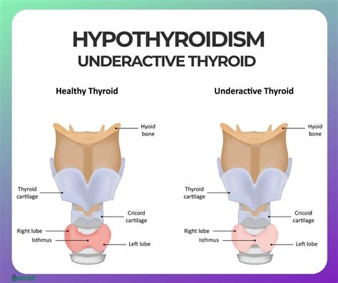 Hypothyroidism Underactive Thyroid Symptoms Causes Risk Groups
