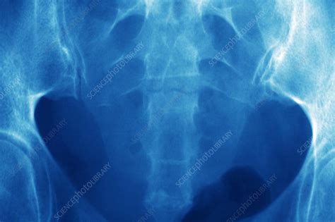 Pelvic Spine Fracture X Ray Stock Image M3301348 Science Photo