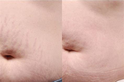 laser stretch mark removal before and after bridgewater ma horizons health and wellness