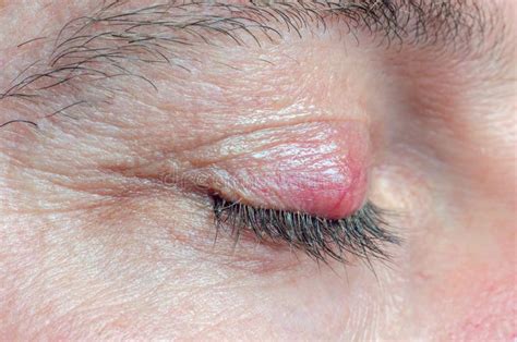 Chalazion On The Eyelid Of A Man Close Up Stock Image Image Of