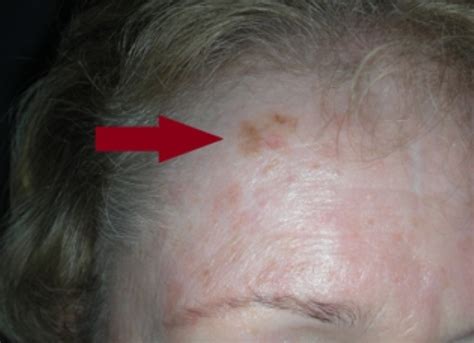 Melanoma Forehead Pictures Symptoms And Pictures