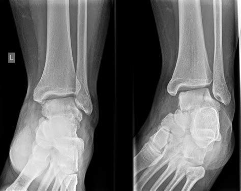Talus Lateral Process Fracture