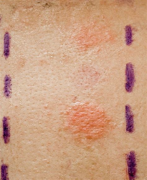 Skin Allergy Test — Stock Photo © Alidphotos 2272121
