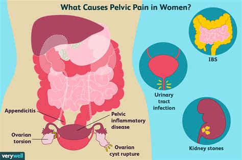 Pelvic Pain Causes In Women And Men And Treatment