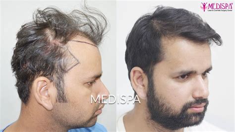 The Global Market For Hair Transplant Has Green Future