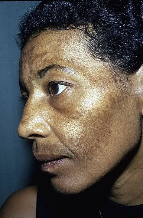Melasma Chloasma Pictures 24 Photos And Images