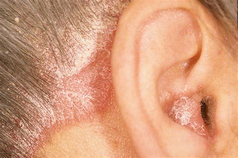 See more ideas about psoriasis diet, psoriasis remedies, treat psoriasis. Psoriasis Picture (Hardin MD Super Site Sample)