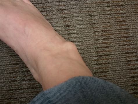 Why Do You Have Lump On Your Ankle Md