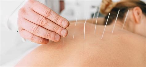 Heres Why Acupuncture Treatments Are Great For You Solea Medical Spa