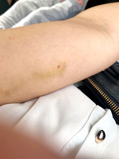 Not ready for another baby yet, I had Implanon | Dyosa The Momma