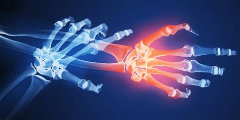 As Causas E Tratamentos Para A Artrose Das Mãos E Dedos Artrite