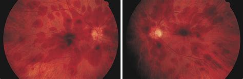 Acute Bilateral Visual Loss Associated With Retinal Hemorrhages