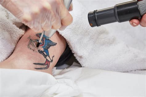 Laser Tattoo Removal Professional Effective Lynton Clinic Cheshire
