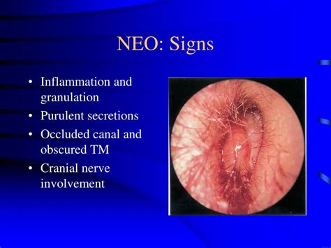 Ppt Diseases Of The External Ear Powerpoint Presentation Free