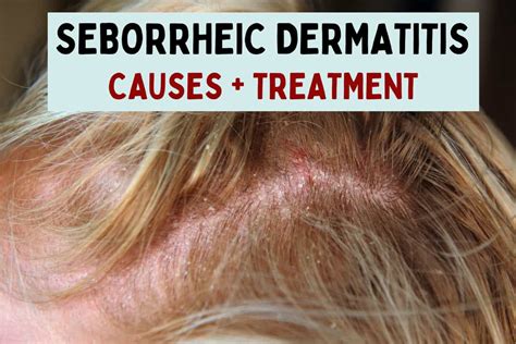 Seborrheic Dermatitis Symptoms Causes And Treatments