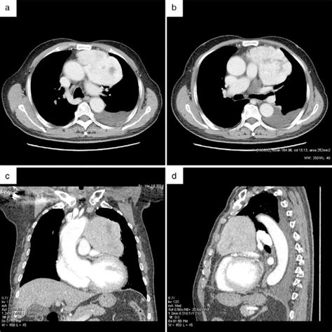 Chest Computed Tomography Ct Scan Showed A Significantly Enhanced