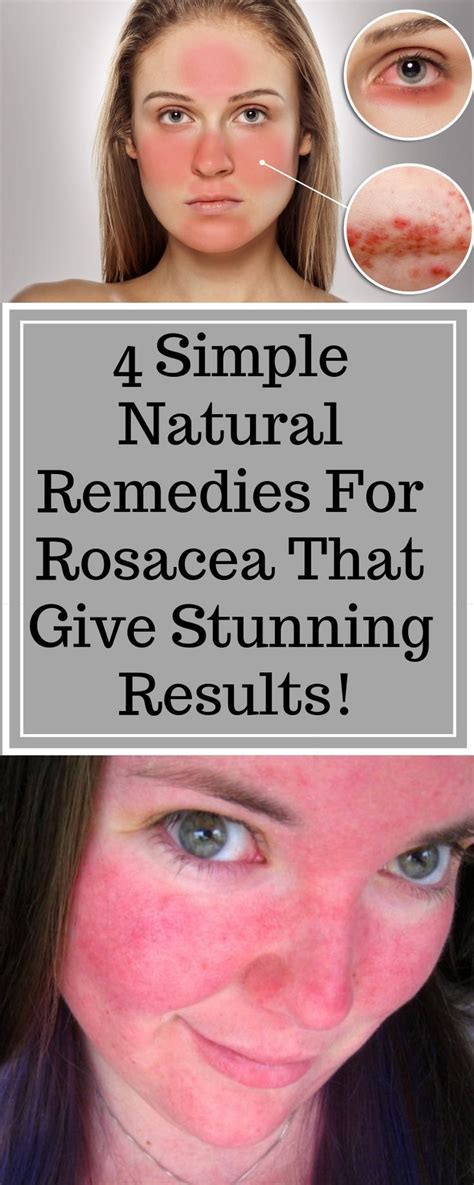 4 Simple Natural Remedies For Rosacea That Give Stunning Results