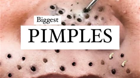 Largest And Best Pimples Of 2020 Lets Pop Some Big Pimples Youtube