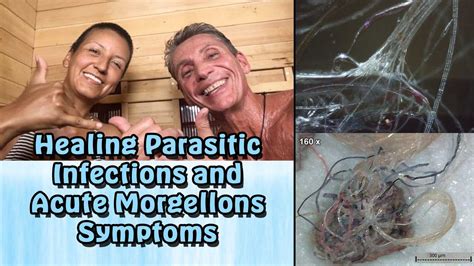 Healing Parasitic Infections And Acute Morgellons Symptoms Earther