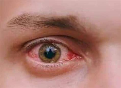 Inilah Penyakit Yang Bisa Sebabkan Mata Sering Gatal