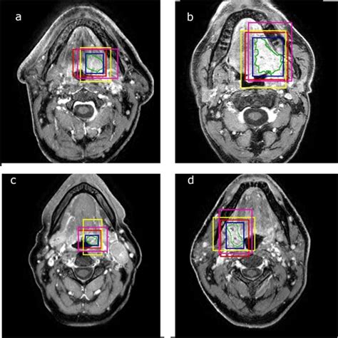 Oropharyngeal Primary Tumor Segmentation For Radiotherapy Planning On