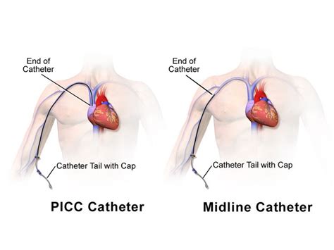 Picc Line Vs Midline Catheter Nursing Clinical Skills