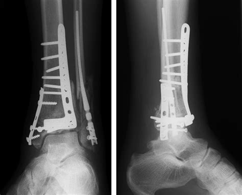 Type C Tibial Pilon Fractures Bone And Joint