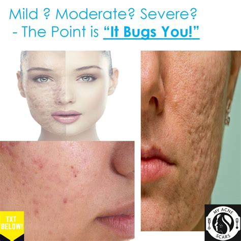What Its Like To Have Acne Scars Acne Powerful Message My Acne Scars