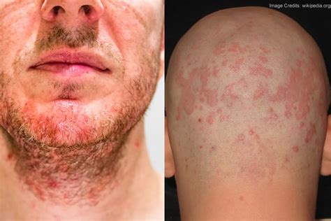 Dermatite Seborroica Come Riconoscerla E Come Trattarla Porn Sex