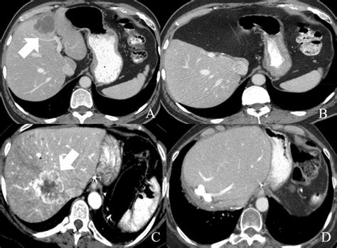 Resectable Intrahepatic Cholangiocarcinoma In 2 Different Patients A