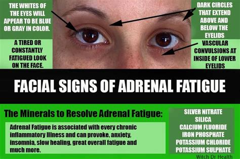 The Facial Signs Of Adrenal Fatigue Endocrineautoimmune Signs Of