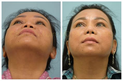 Dallas Revisioncorrective Rhinoplasty Before And After Photos Plano