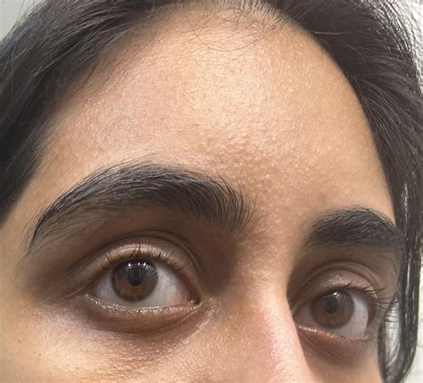 Tiny Bumps All Over Face Rdermatology